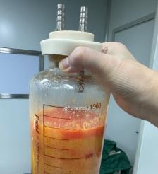 澳门水动力吸脂手术要做多久？
